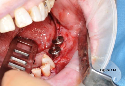 suture implant