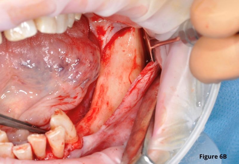 Mandibular incision