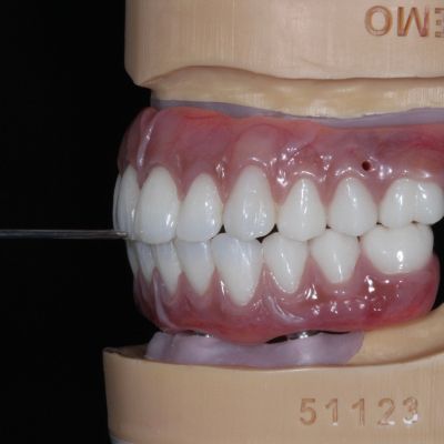 Aligned mandible