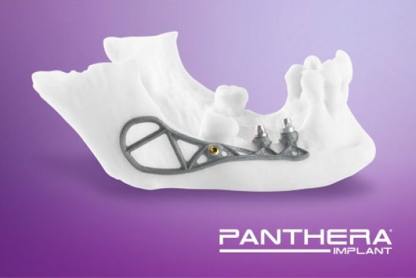 Panthera Implant