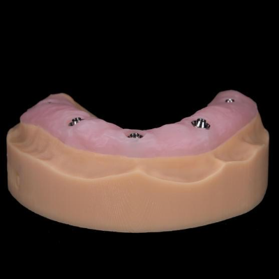 Gums over abutments