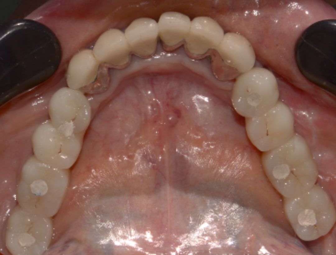 Dental Prosthetic Blog