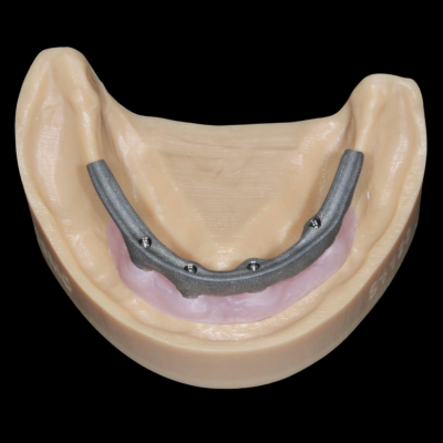 Lower abutments