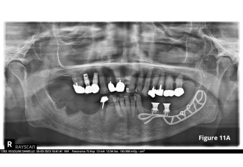 Rayscan implant