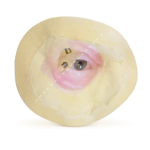 Eye_anaplastology