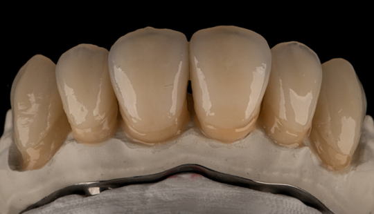 Lower abutments