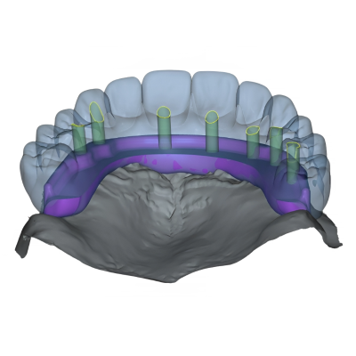 Post-Op Temp off the Model
