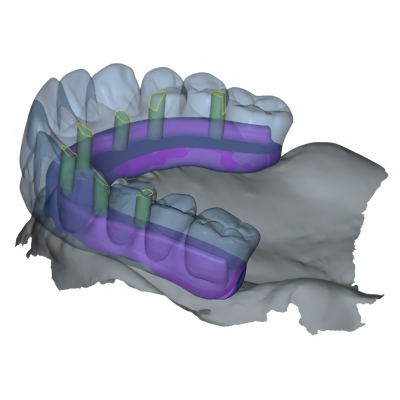 Post-Op Temp off the Model