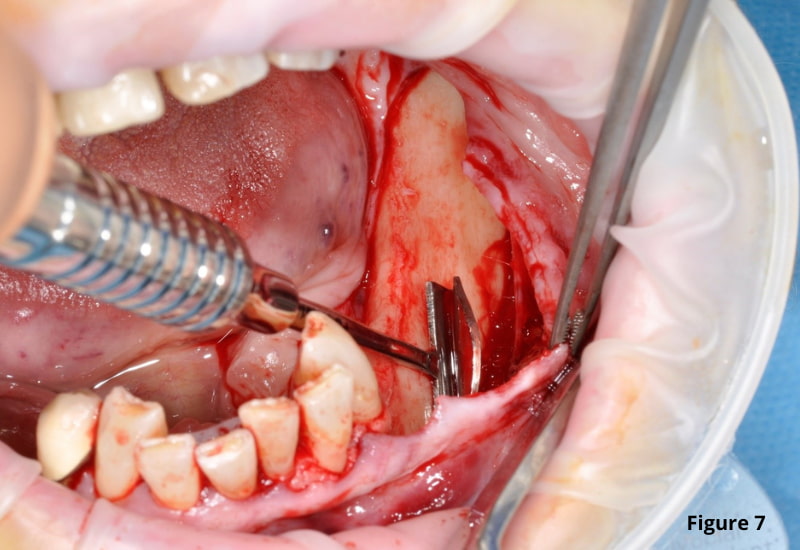Atraumatic periosteal