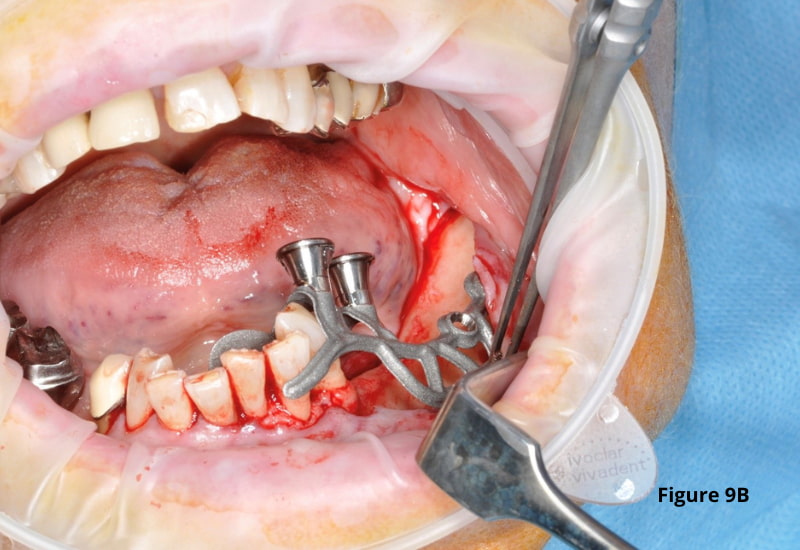 bony surface implant_2