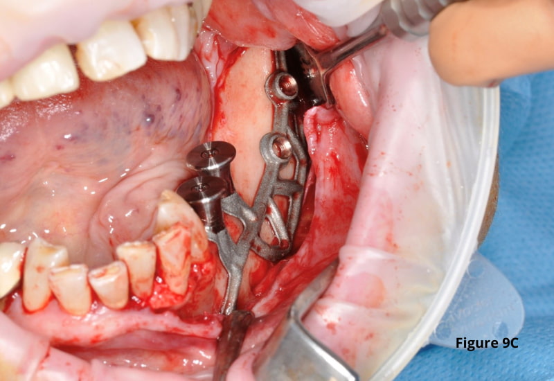 bony surface implant_3