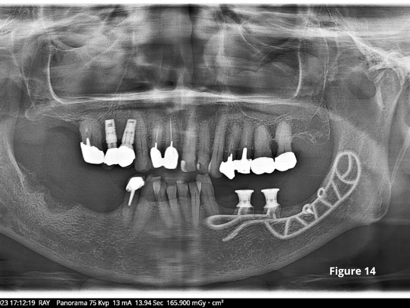 Patient X-ray