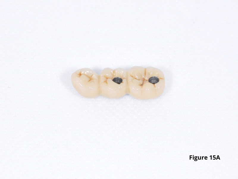 Permanent dentures