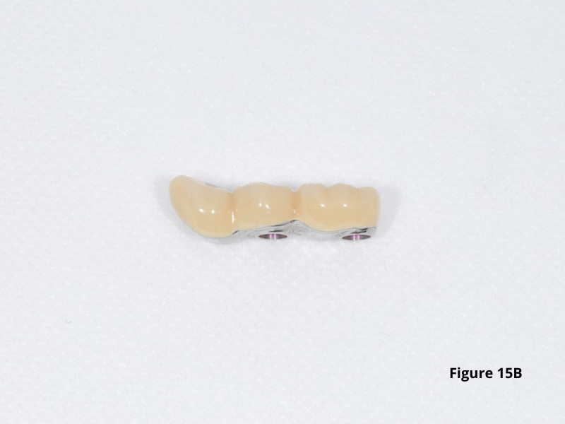 Permanent dentures_1