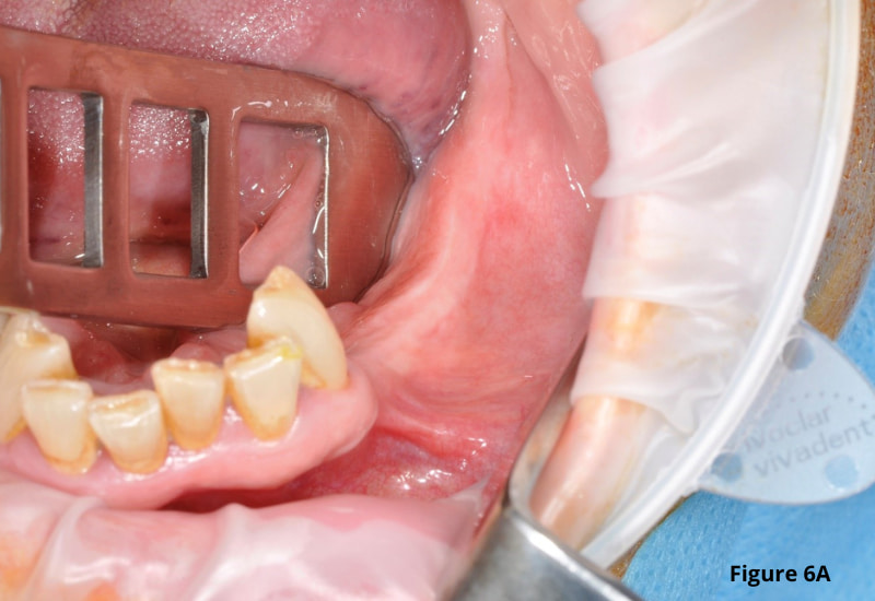 Mandibular procedure