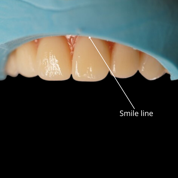 Lower bar