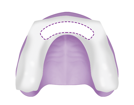 Upper Anterior