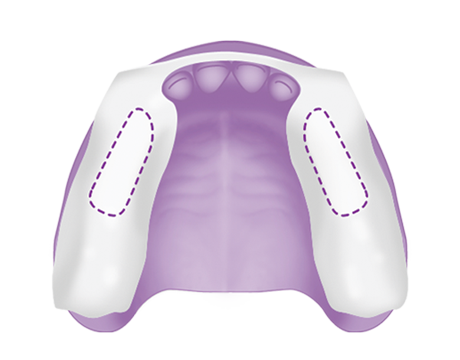 Upper Lateral