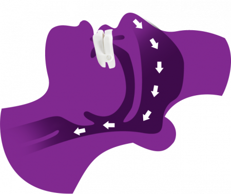 Mandibular repositioning devices