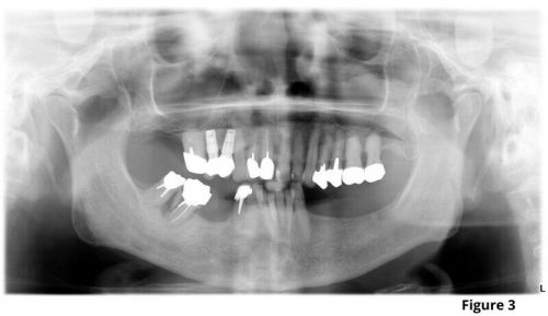 Mandibular molar panoramic